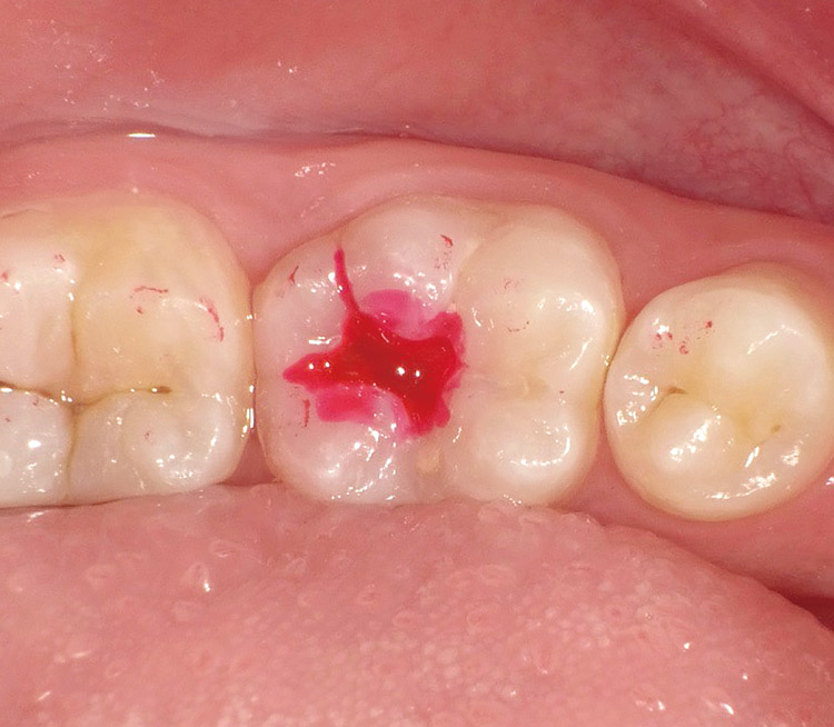 図7 う蝕検知液による染色。