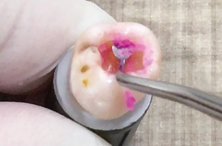 図31 2回目のう蝕検知液染色部を慎重に除去開始。