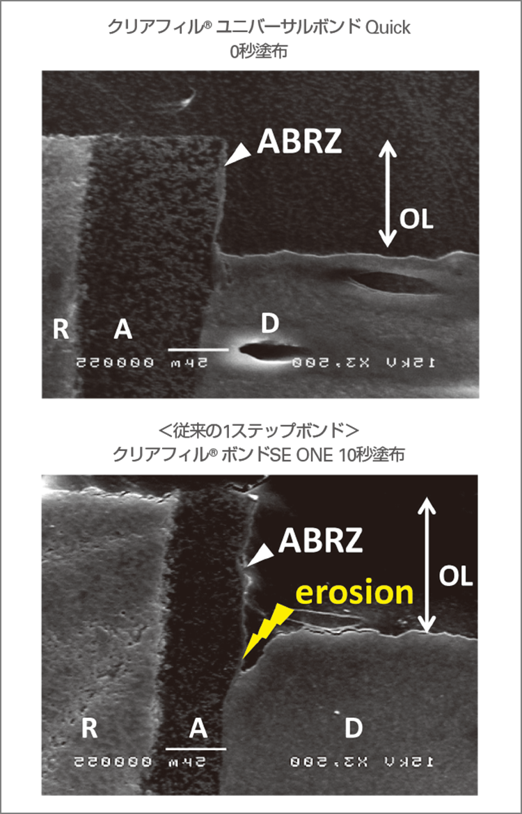 クリアフィル®ユニバーサルボンドQuickの接着界面　R：CR層　A：ボンド層　D：象牙質層　OL：脱灰層　ABRZ：酸塩基抵抗層（データ提供：東京医科歯科大学大学院う蝕制御学分野　高垣智博先生、松井七生子先生）