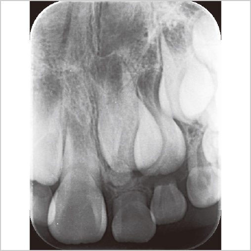 乳中切歯根尖相当部および未萌出の上顎左側中切歯切縁付近のレントゲン写真