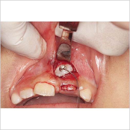 中切歯開窓術および牽引用リンガルボタン接着時の写真