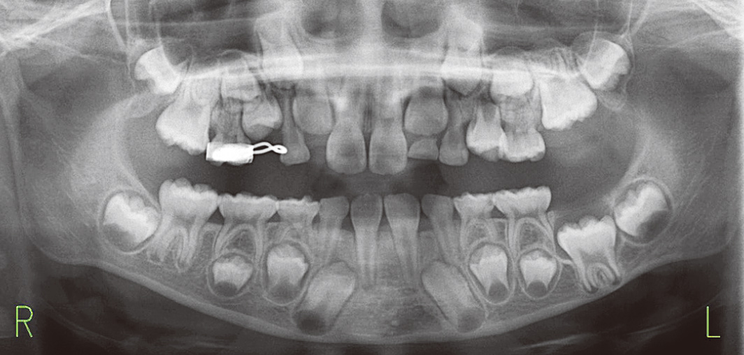 初診時パノラマX線写真