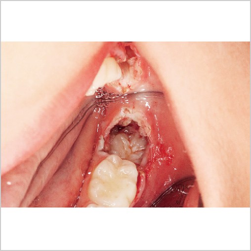 下顎左側第一大臼歯開窓術中の写真
