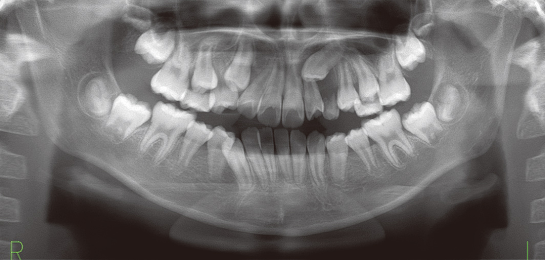 初診時パノラマX線写真像