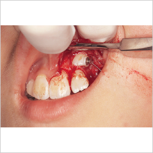 犬歯開窓術中および牽引用リンガルボタン接着時の写真