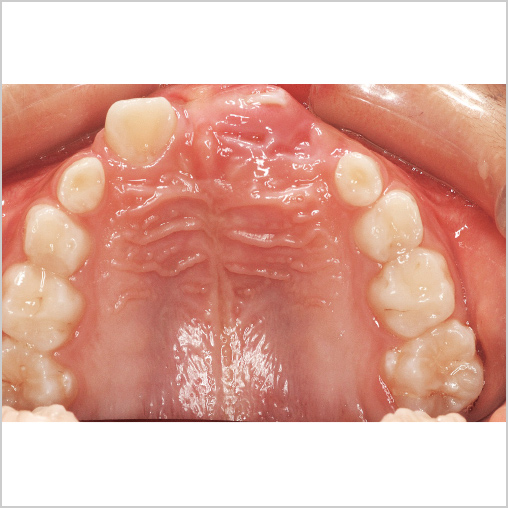 初診時上顎咬合面観の写真