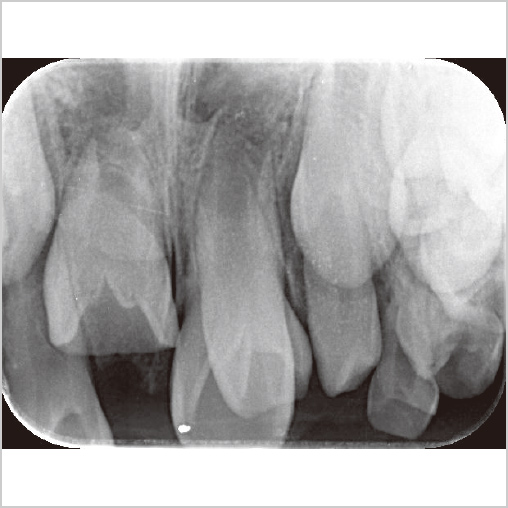 初診時口内法X線写真像
