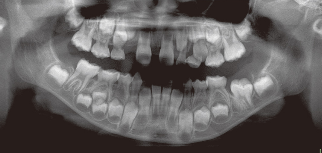 初診時パノラマX線写真像
