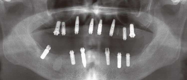 インプラント14本を一度に埋入した。