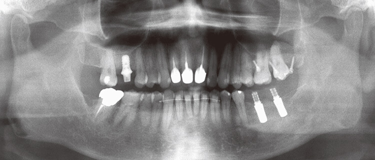 広範囲の手術でなくとも、両側大臼歯の手術は食事も困難になると考える。