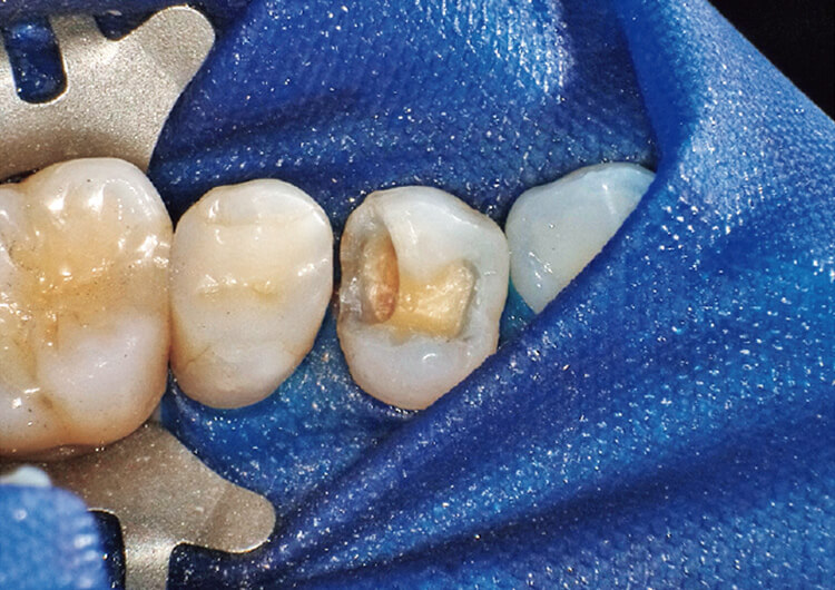 メタルインレー除去と感染象牙質の削除。う蝕検知液を指標に感染象牙質を削除する。窩洞形成が終了。歯肉側マージンがラバーシートでしっかりと防湿されているのが確認できる。