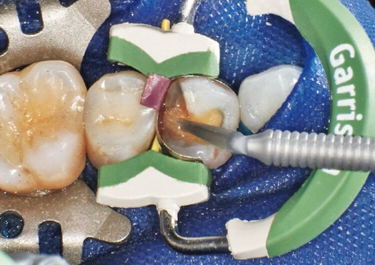 クリアフィルメガボンド2 プライマーによる歯面処理を行う。窩洞内に十分にプライマーを塗布する。