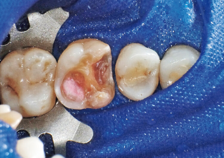MOメタルインレーの二次う蝕の症例。インレー除去後、う蝕検知液を指標に感染象牙質の削除を行い窩洞形成が終了したところ。