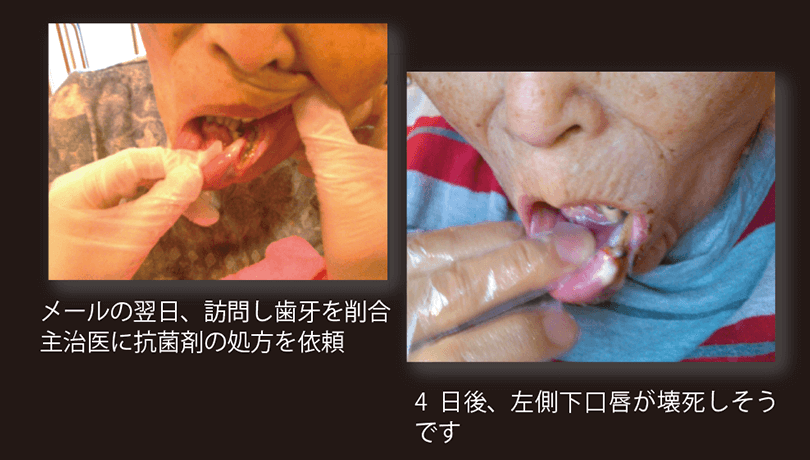 脳梗塞の後遺症左麻痺で口唇を噛み込んでしまった患者さん。