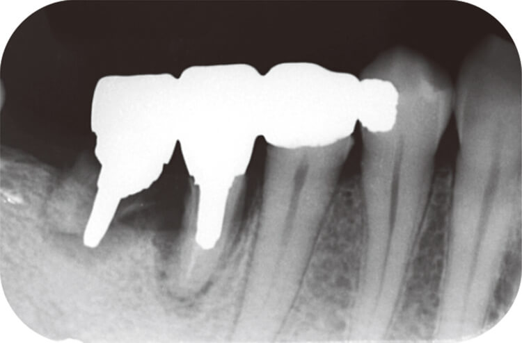歯根破折により抜歯適応となった右側下顎第一大臼歯。