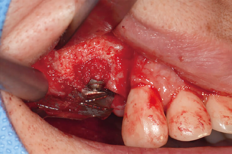 （別症例）Tiハニカムメンブレンを口蓋側に固定し、周囲からの自家骨粉砕骨を露出部に充填。