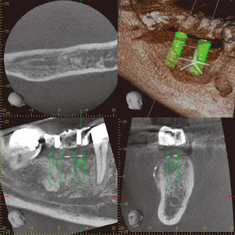 veraviewepocs 3Df によるCT画像。第一大臼歯相当部では垂直的骨欠損部の骨新生が認められた。