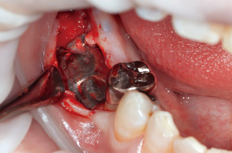 粘膜骨膜弁を剥離翻転すると、軟組織の迷入が一切認められないTiハニカムメンブレンの表面を露出できた。