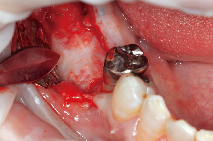 ピンセットで容易にTiハニカムメンブレンを除去でき、裏面にも軟組織の付着はなかった。骨増生術から3ヵ月経過した時点であったが、十分な新生骨が獲得できた。