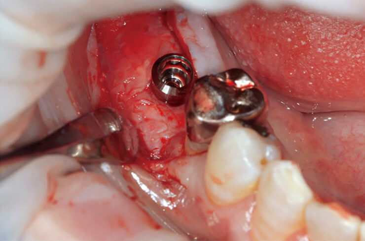 第一大臼歯および第二大臼歯部に直径4.8mmのインプラントを埋入した。