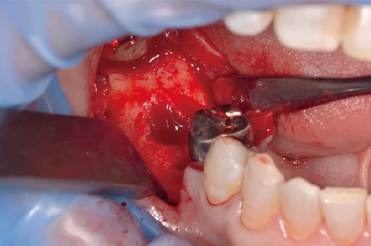 抜歯窩に残存した軟組織を除去した後、ラウンドバーなどを用いて抜歯窩内の骨を穿孔し血流を得た。