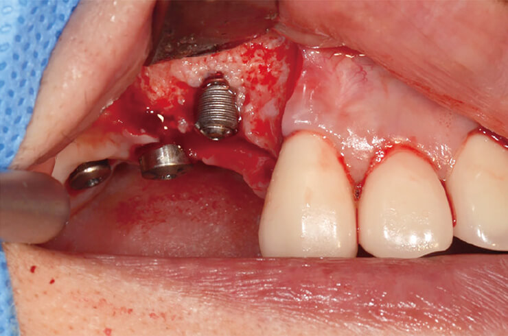 （別症例）右側上顎第一小臼歯部のインプラント周囲炎。軟組織を除去すると頰側のスレッドが露出した。