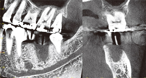 58歳、男性。#36・37欠損で抜歯後3ヵ月経過しインプラント術前検査。