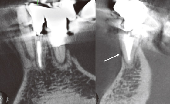 図7症例のCBCT画像。