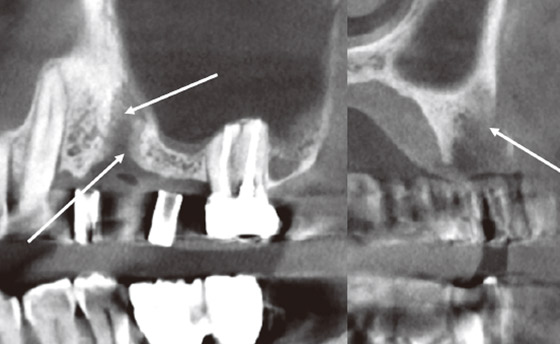 抜歯後5ヵ月経過で、抜歯窩全体に石灰化が広がっているが、顎堤頂までには達していない（矢印）。