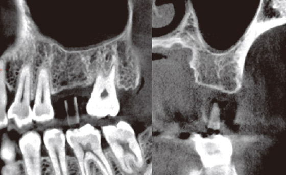 #26抜歯後、約1年経過した。抜歯窩は骨梁で埋められ、顎堤頂の皮質化も見られる。