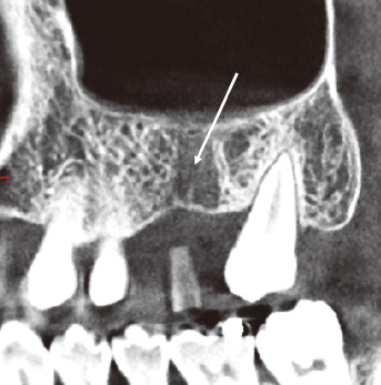 図18症例の口蓋根部の抜歯窩は、骨梁形成がなされておらず脆弱な状態を呈する（矢印）。