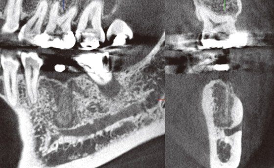 50歳、女性。#36抜歯後1年2ヵ月経過により、抜歯窩内は骨補填材を主体に全体に石灰化しているようであるが幼弱で骨梁形成に至っていない。骨脆弱症を呈する。