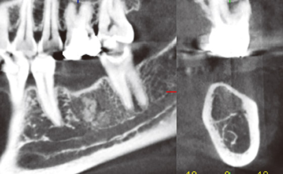 48歳、女性。#36抜歯後2年経過するも、骨補填材と幼弱な石灰化のままで、骨梁形成がなされず骨脆弱症を呈する。