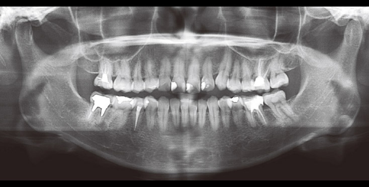 ＜症例1 エンド症例（2010年4月初診）＞　術前パノラマX線写真。