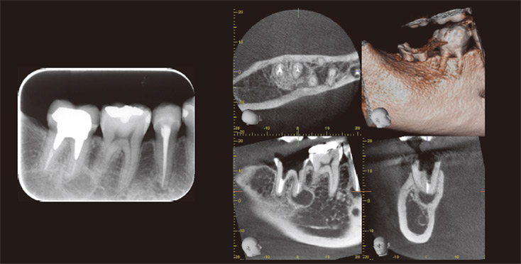 右下臼歯部　術前デンタルX線写真とCT画像。