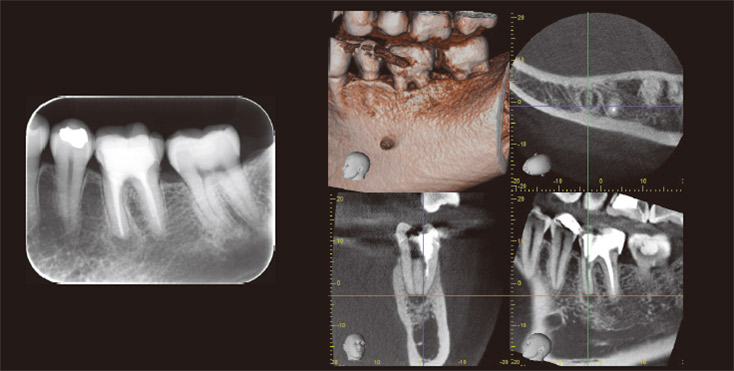左下臼歯部　術前デンタルX線写真とCT画像。
