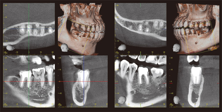 右下・左下臼歯部　術後CT画像。