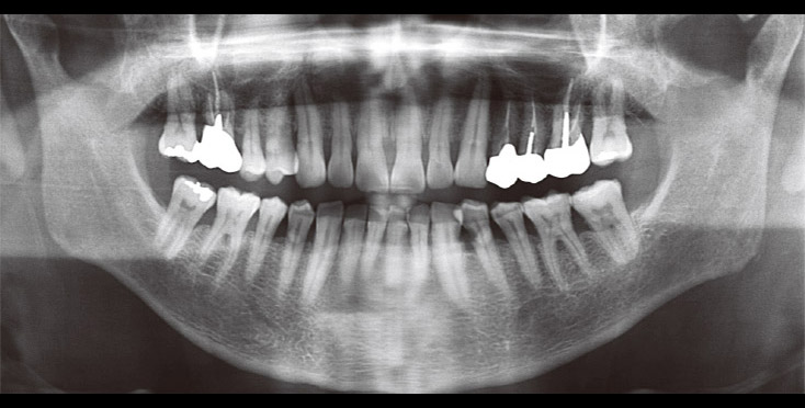 ＜症例2 ペリオ症例（2011年2月初診）＞　術前パノラマX線写真。