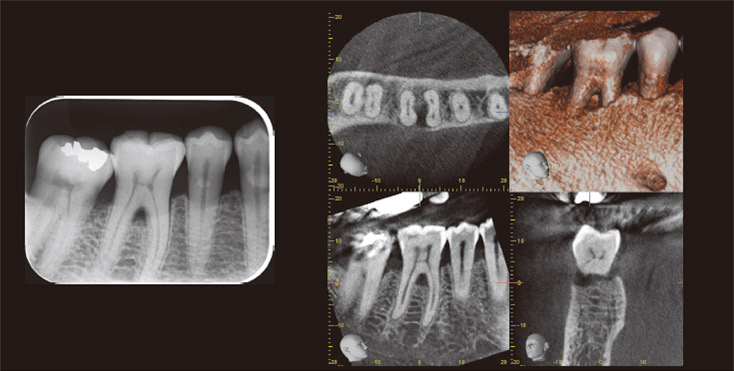 右下臼歯部　術前デンタルX線写真とCT画像。