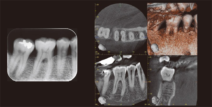右下臼歯部　術後デンタルX線写真とCT画像
