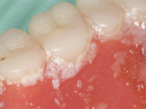図1 多量に付着した義歯性プラーク。誤嚥性肺炎や義歯性口内炎の原因となる