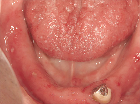 図2 義歯性口内炎及び口腔カンジタ症。