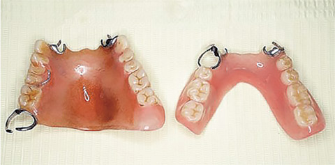 図5 喫煙者の義歯。口蓋に多量の着色が付着している。歯石と着色が混在して付着している様子が見て取れる。