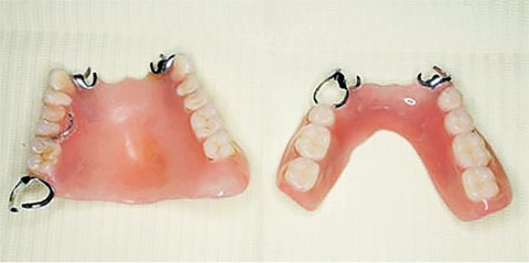 図6 図5の義歯をフィジオクリーンプロ歯石用Ⅱにて洗浄後。
