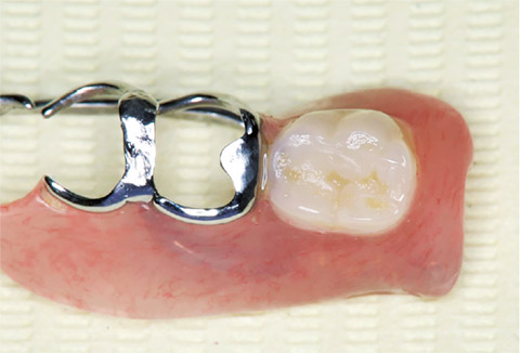 図9 プロケアで「フィジオクリーン」、セルフケアで「歯石くりん」をご使用することで義歯を衛生的に維持している。
