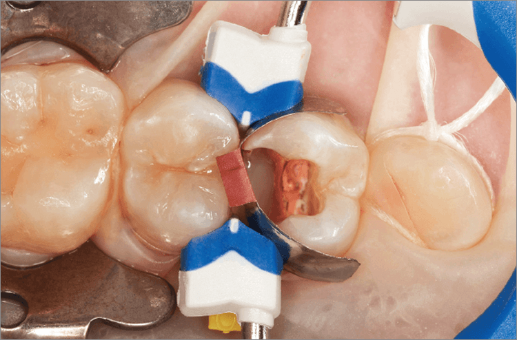 リテーナー設置後、少量のフロアブルコンポジットレジンをマージン部歯頸側に充填した。