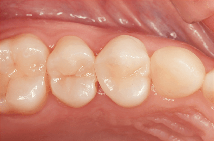 2級ダイレクトボンディング術後1週間。歯牙が吸水し色調の適合も問題なくなっている。