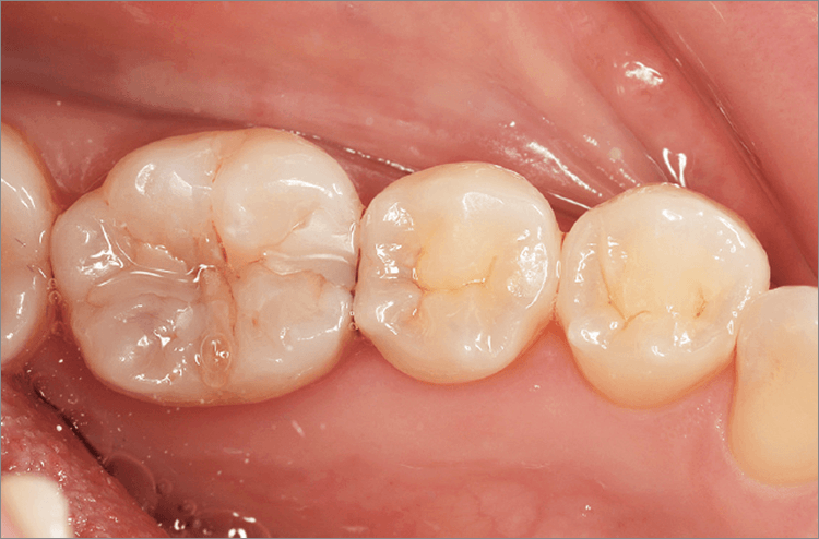 26歳女性。5 6 第2小臼歯ならびに第1大臼歯に2次う蝕を認める。 