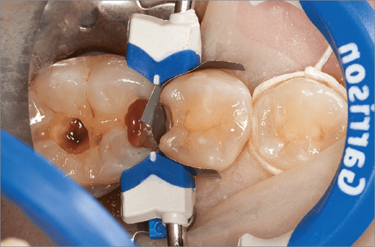 まずは小臼歯にマトリックスならびにリテーナーを設置しダイレクトボンディングを行っていく。