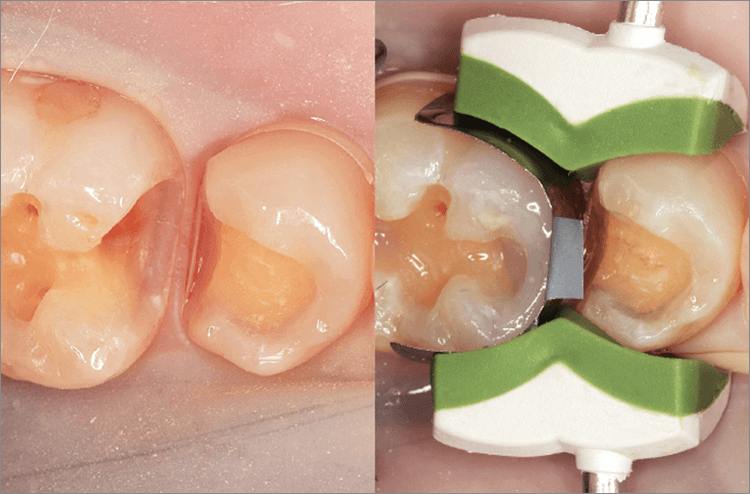 隣在歯の離開距離が多い窩洞6 （左）。その窩洞に3DリテーナーフュージョンLを装着したところ。